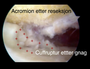 Subacromial dekompresjon